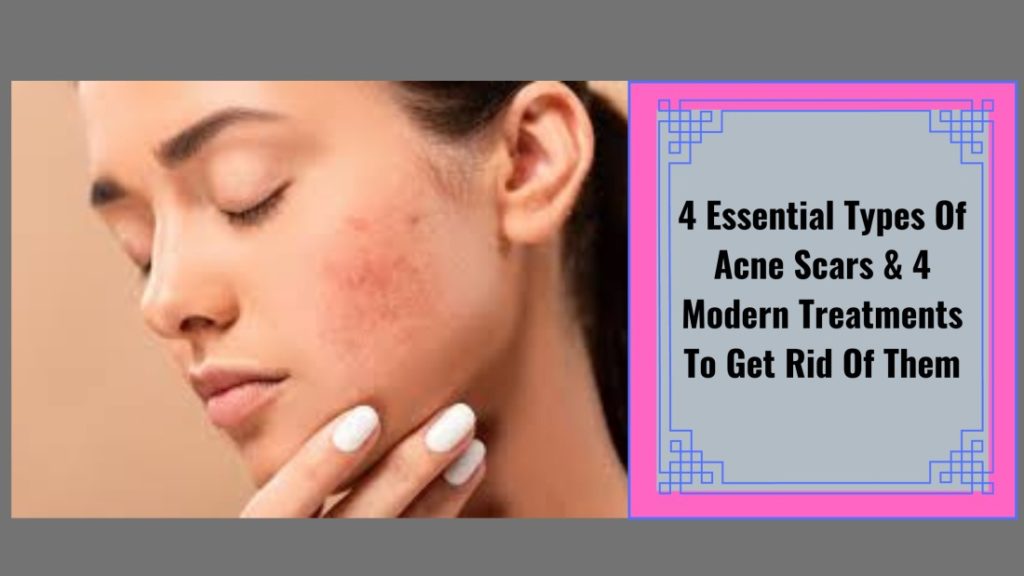 4-essential-types-of-acne-scars-4-modern-treatments-to-get-rid-of-them