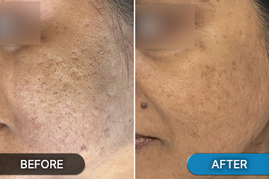 Before-After acne scar treatment at Skinovate Pune