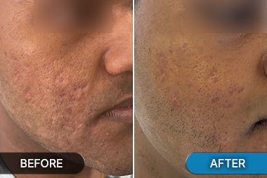 Before-After acne scar removal showing facial marks
