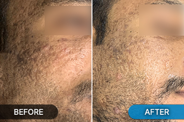Before-After acne scar reduction procedure photo