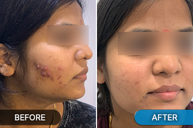 Pre acne scar laser treatment image