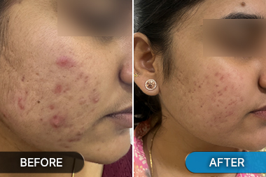 Before-After skin resurfacing for acne scars