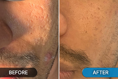 Before-After acne scar correction photo