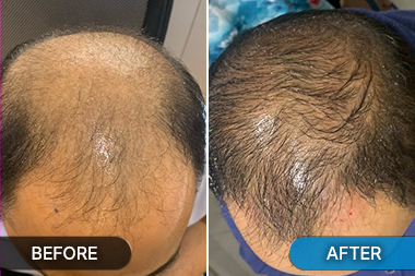 Pre hair restoration photo at Skinovate Pune