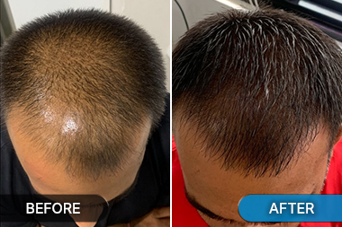 Before-After PRP hair loss treatment photo
