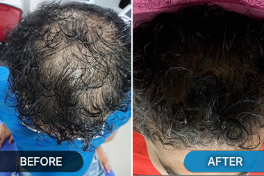 Before-After hair transplant treatment at Skinovate Pune
