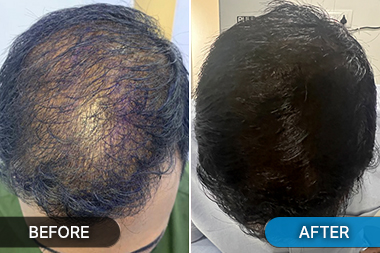 Pre hair transplant photo showing hair thinning