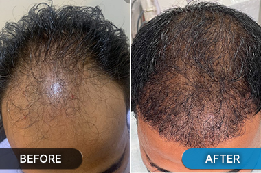 Before-After hair restoration procedure at Skinovate