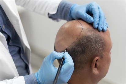Hair transplant marking Before-After surgery at Skinovate Pune