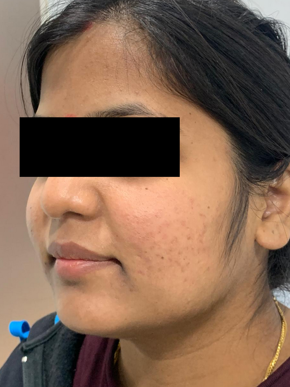 After skin treatment result