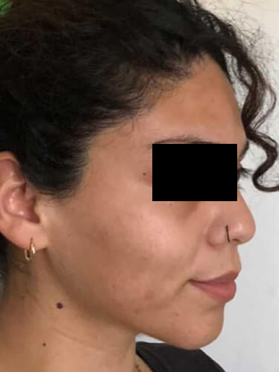 After facial skin treatment photo