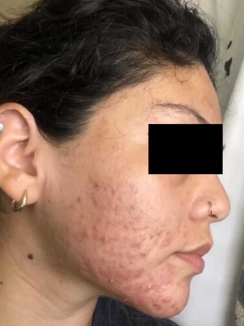 Before facial skin treatment photo