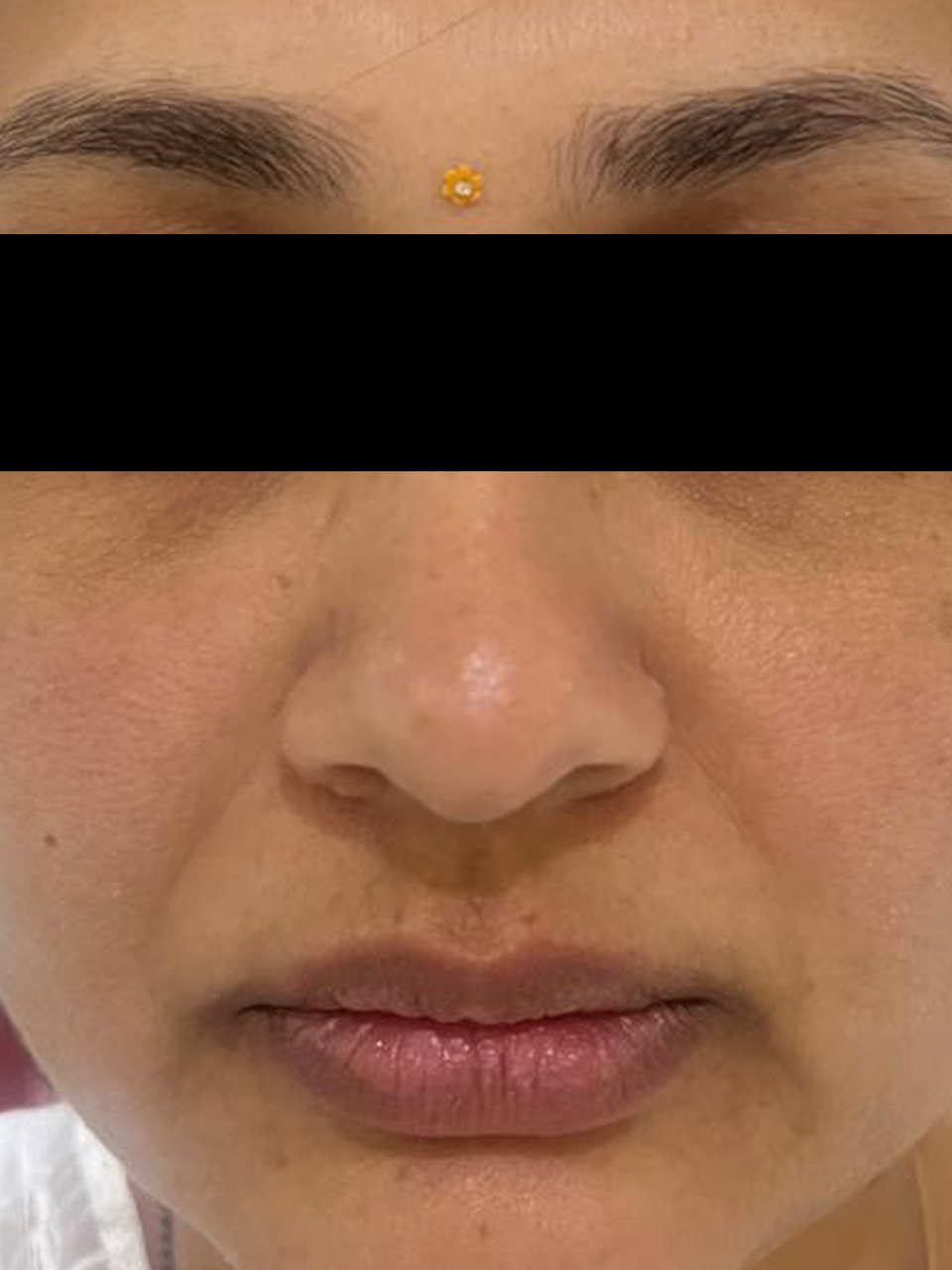 Before skin rejuvenation treatment photo