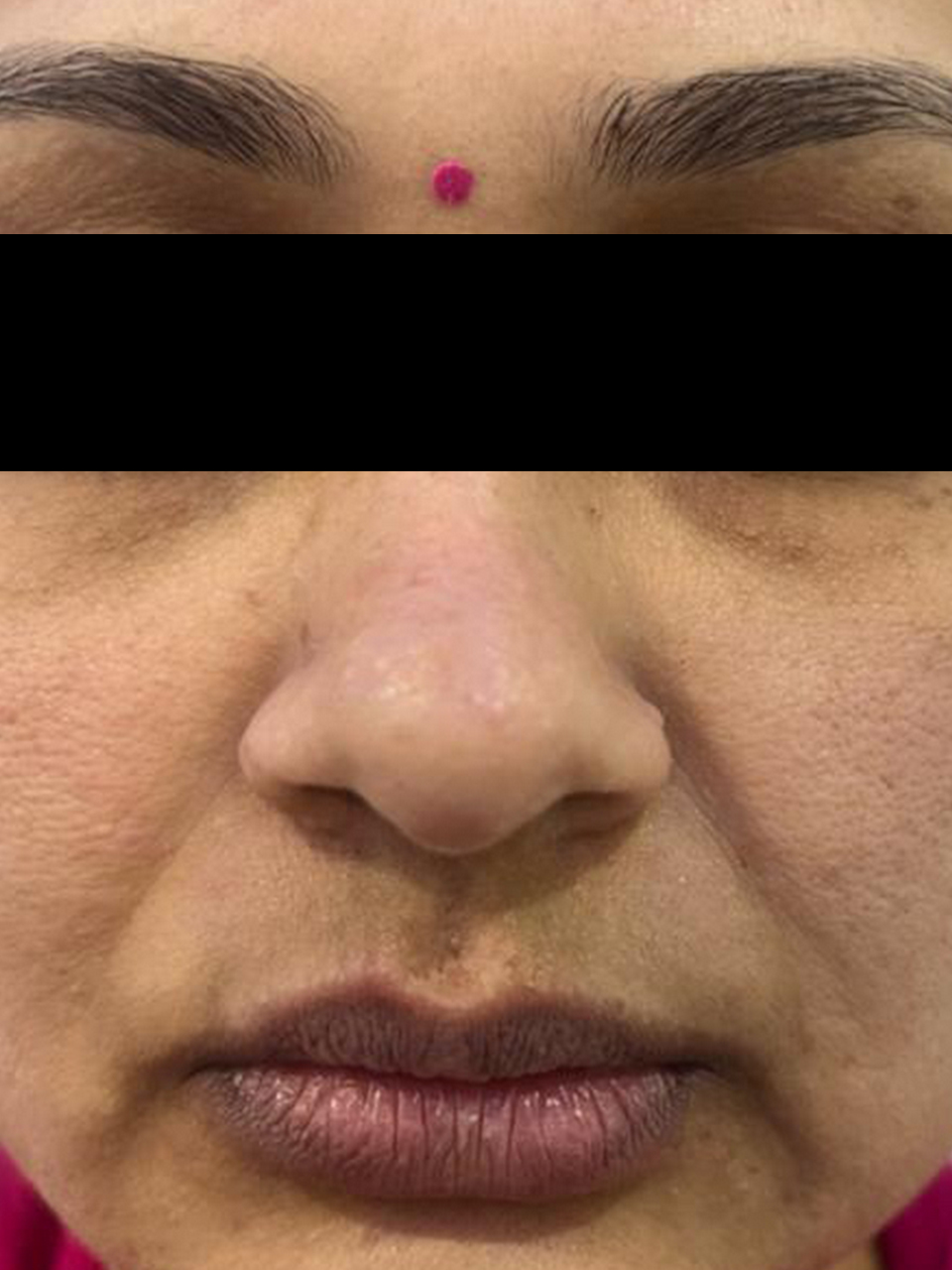 Post skin rejuvenation treatment result