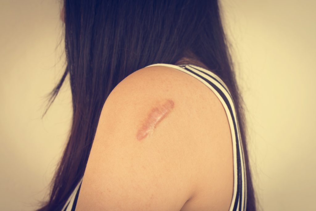 keloid-scars-causes-symptoms-treatment